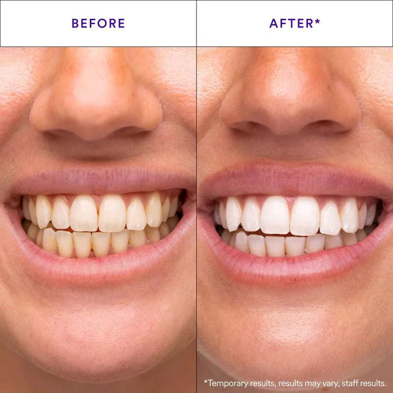 Teeth Whitening Strips