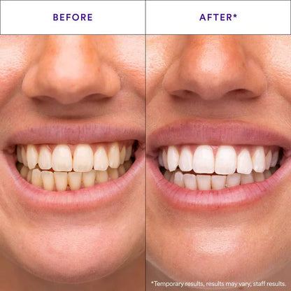 Teeth Whitening Strips